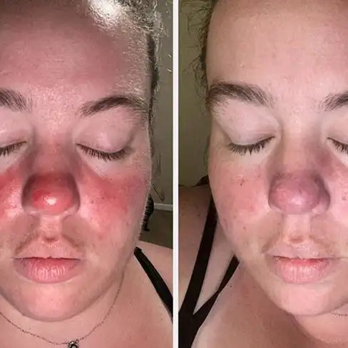 Piel Rosacea